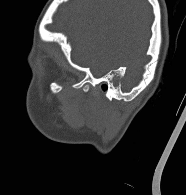 Cerebellar abscess (Radiopaedia 73727-84527 Sagittal bone window 33).jpg