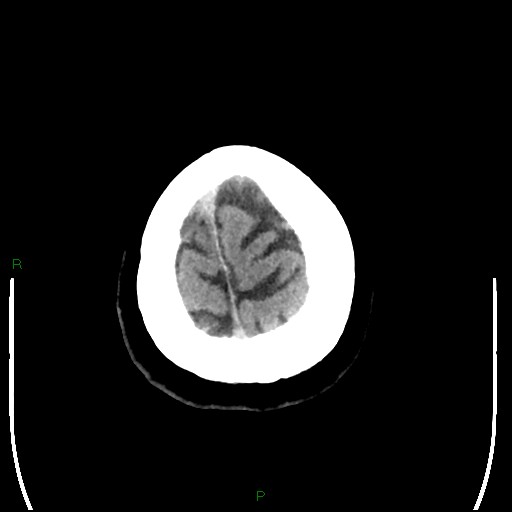 File:Cerebellar abscess (Radiopaedia 78135-90671 Axial non-contrast 104).jpg