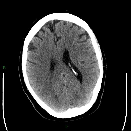 Cerebellar abscess (Radiopaedia 78135-90671 Axial non-contrast 68).jpg