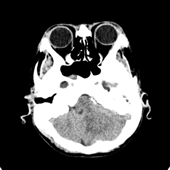 File:Cerebellar abscess secondary to mastoiditis (Radiopaedia 26284-26412 Axial non-contrast 29).jpg