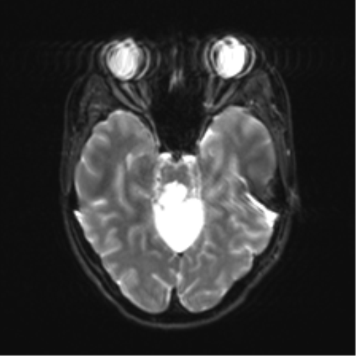 Cerebellar agenesis with hypoplastic pons (pontocerebellar hypoplasia) (Radiopaedia 57224-64138 Axial DWI 14).png