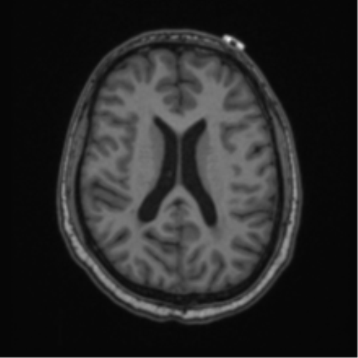 Cerebellar hemangioblastomas and pituitary adenoma (Radiopaedia 85490-101176 Axial T1 45).png