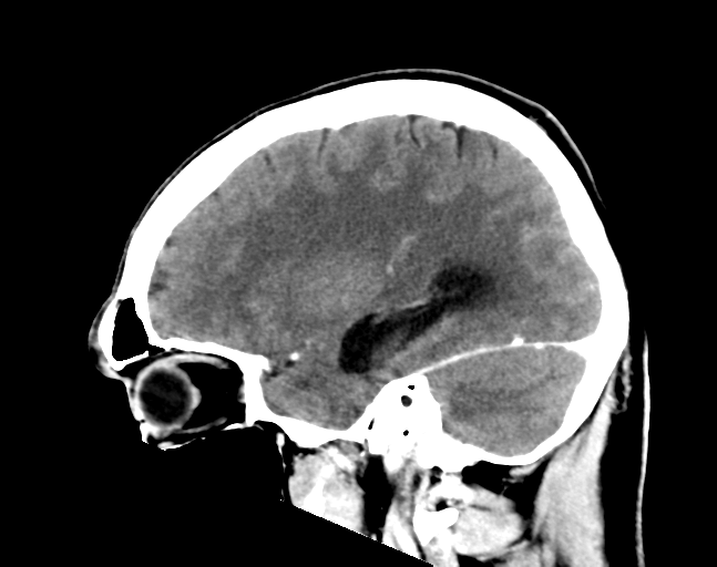 File:Cerebellar hemorrhage (Radiopaedia 37000-38671 Sagittal C+ 25).png