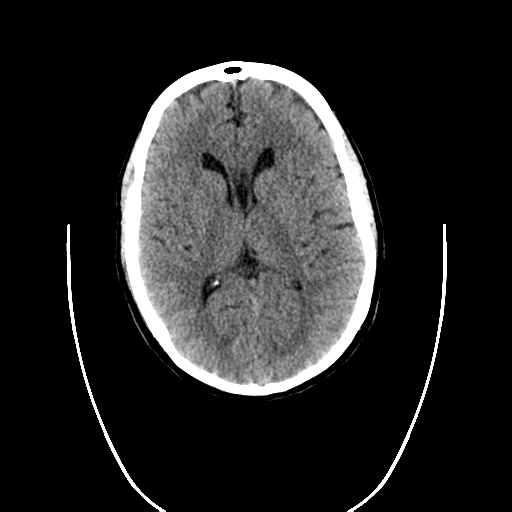 File:Cerebellar infarct due to vertebral artery dissection with posterior fossa decompression (Radiopaedia 82779-97032 Coronal non-contrast 1).png