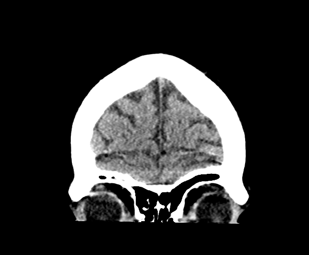 File:Cerebellar infarct due to vertebral artery dissection with posterior fossa decompression (Radiopaedia 82779-97032 Coronal non-contrast 7).png