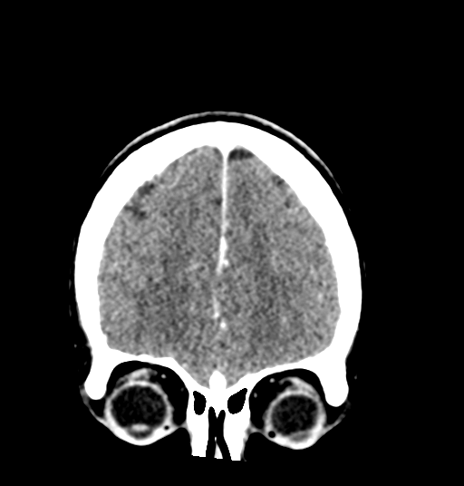 Cerebellar metastases - colorectal adenocarcinoma (Radiopaedia 40947-43652 Coronal C+ 21).png