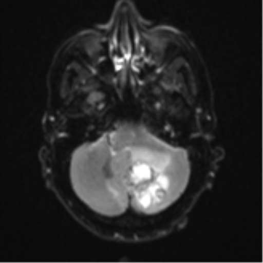 Cerebellar metastasis (Radiopaedia 51137-56765 Axial DWI 7).png