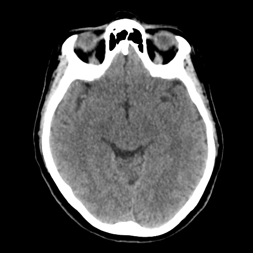Cerebellar metastasis (cystic appearance) (Radiopaedia 41395-44258 Axial non-contrast 24).png