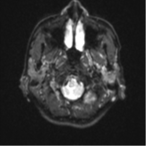 Cerebellar metastasis - adenocarcinoma lung (Radiopaedia 63184-71715 Axial DWI 2).png