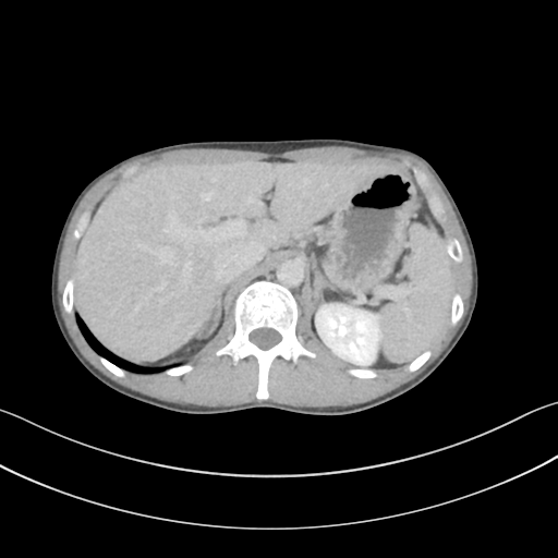 Cerebellar metastasis - adenocarcinoma lung (Radiopaedia 63184-71717 Axial C+ delayed 68).png