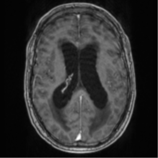 Cerebellar metastasis from lung adenocarcinoma (Radiopaedia 86690-102829 Axial T1 C+ 47).png