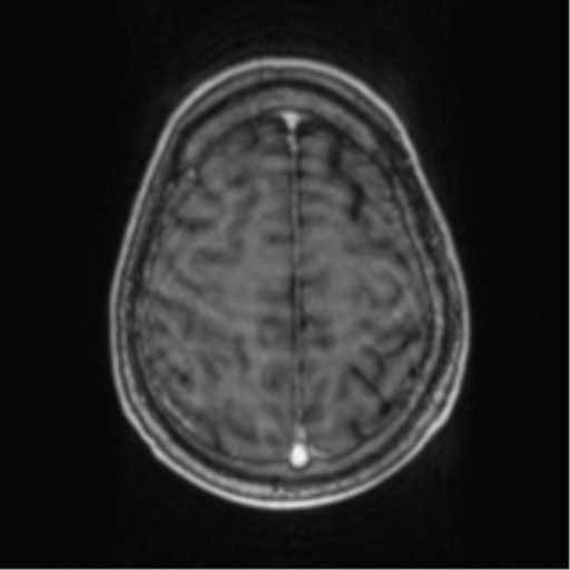 Cerebellar metastasis from lung adenocarcinoma (Radiopaedia 86690-102829 Axial T1 C+ 64).png