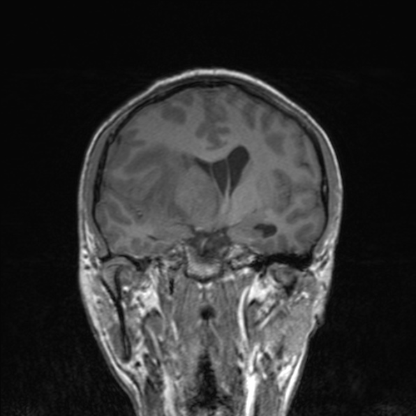 Cerebral abscess (Radiopaedia 24212-24478 Coronal T1 104).jpg