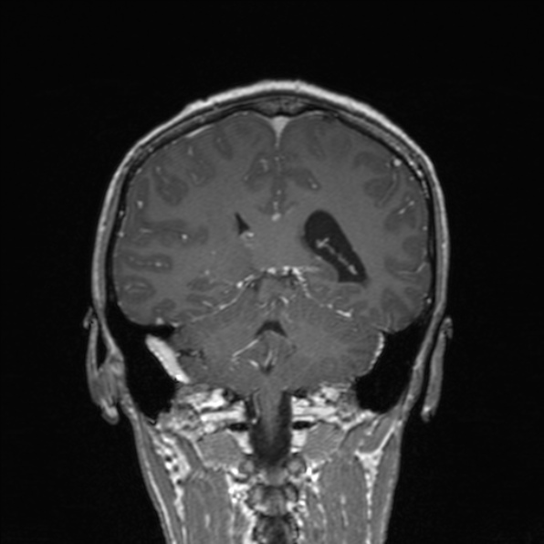 Cerebral abscess (Radiopaedia 24212-24478 Coronal T1 C+ 137).jpg