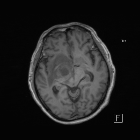 Cerebral abscess (Radiopaedia 26111-26247 Axial T1 29).jpg