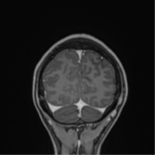 File:Cerebral abscess (Radiopaedia 60342-68009 H 3).png