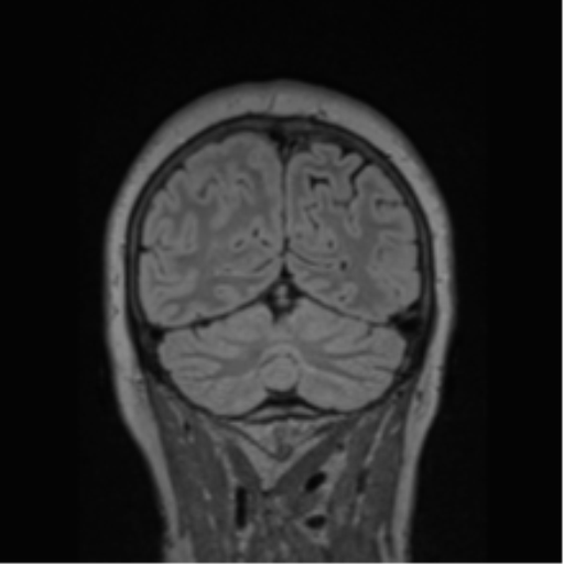 Cerebral abscess from pulmonary arteriovenous malformation (Radiopaedia 86275-102291 Coronal FLAIR 23).png