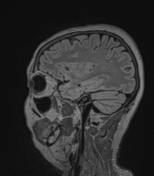Cerebral abscess from pulmonary arteriovenous malformation (Radiopaedia 86275-102291 Sagittal FLAIR 22).png