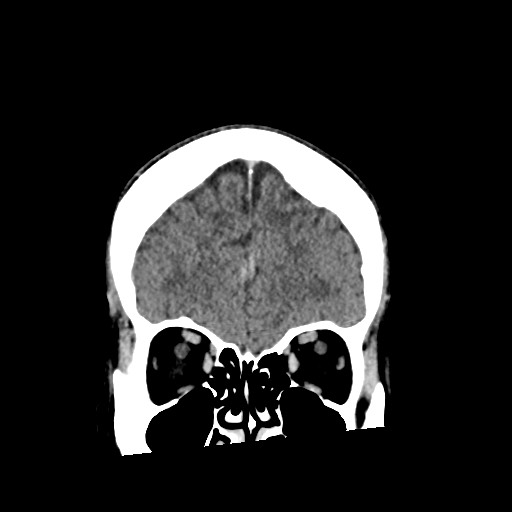 Cerebral amyloid angiopathy-related inflammation (Radiopaedia 74836-85848 Coronal non-contrast 17).jpg