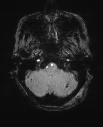 File:Cerebral amyloid angiopathy-related inflammation (Radiopaedia 74836-85849 Axial SWI 11).jpg