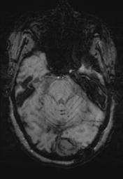 File:Cerebral amyloid angiopathy (Radiopaedia 29129-29518 Axial SWI MPR 10).jpg