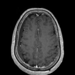 Cerebral amyloid angiopathy (Radiopaedia 29129-29518 Axial T1 C+ 108).jpg