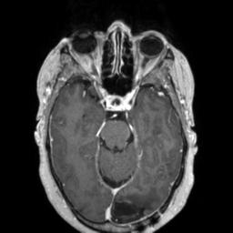Cerebral amyloid angiopathy (Radiopaedia 29129-29518 Axial T1 C+ 56).jpg