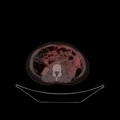 Cerebral and abdominal tuberculosis (Radiopaedia 90499-107853 C 173).jpg