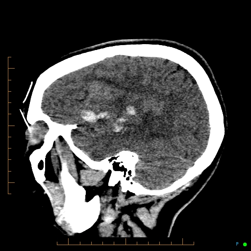 Cerebral arteriovenous malformation (AVM) (Radiopaedia 78162-90706 A 20).jpg