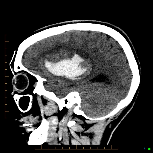 Cerebral arteriovenous malformation (AVM) (Radiopaedia 78162-90706 A 24).jpg