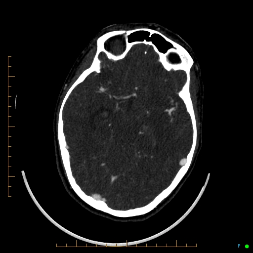 Cerebral arteriovenous malformation (AVM) (Radiopaedia 78162-90706 Axial CTA 121).jpg