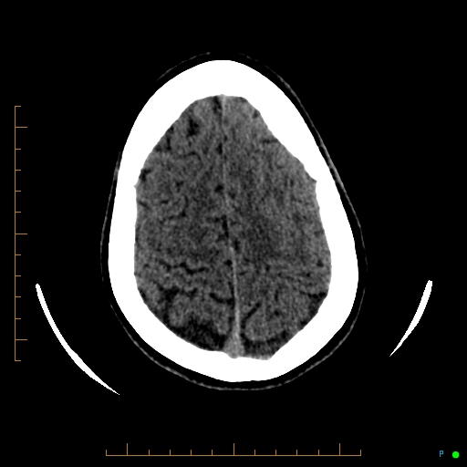 Cerebral arteriovenous malformation (AVM) (Radiopaedia 78162-90706 Axial non-contrast 53).jpg