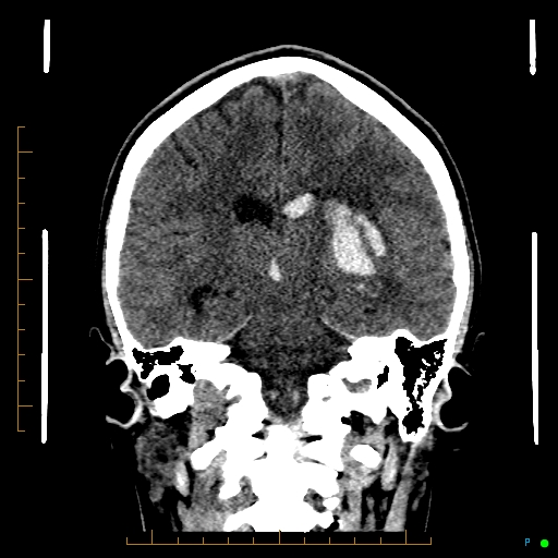 Cerebral arteriovenous malformation (AVM) (Radiopaedia 78162-90706 Coronal non-contrast 57).jpg