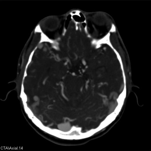 File:Cerebral arteriovenous malformation (Radiopaedia 28518-28759 B 14).jpg
