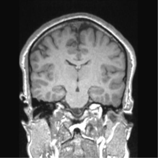 Cerebral arteriovenous malformation (Radiopaedia 39259-41506 Coronal T1 46).png