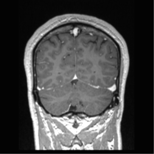 Cerebral arteriovenous malformation (Radiopaedia 39259-41506 Coronal T1 C+ 24).png