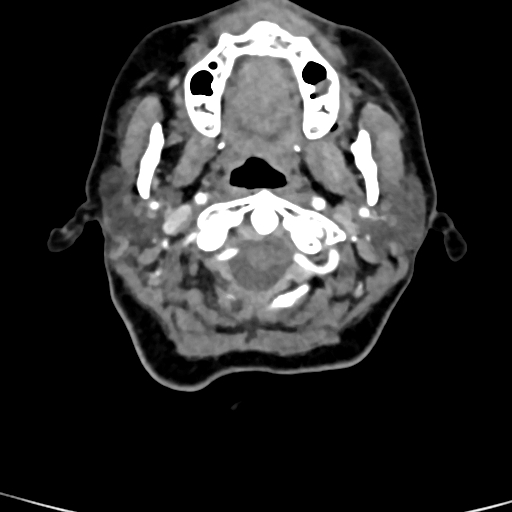 Cerebral arteriovenous malformation (Radiopaedia 73830-84645 B 96).jpg