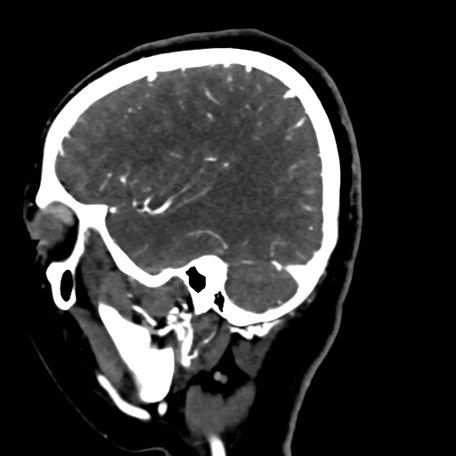 File:Cerebral arteriovenous malformation (Radiopaedia 73830-84645 Sagittal C+ delayed 21).jpg