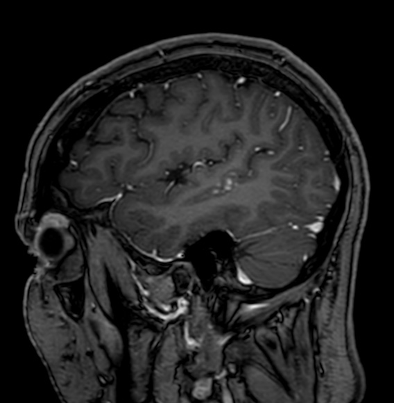 Cerebral arteriovenous malformation (Radiopaedia 74411-85746 Sagittal T1 C+ 22).jpg