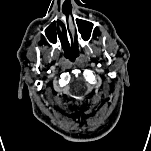 Cerebral arteriovenous malformation (Radiopaedia 78188-90746 Axial C+ delayed 8).jpg
