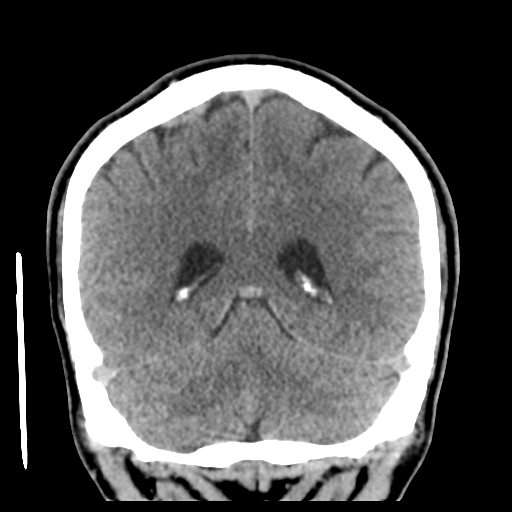 Cerebral arteriovenous malformation (Spetzler-Martin grade 2) (Radiopaedia 41262-44076 Coronal non-contrast 45).png