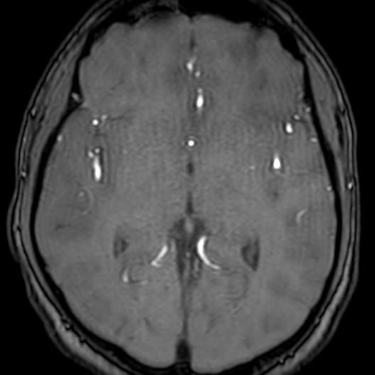 Cerebral arteriovenous malformation at posterior body of corpus callosum (Radiopaedia 74111-84925 Axial MRA 103).jpg