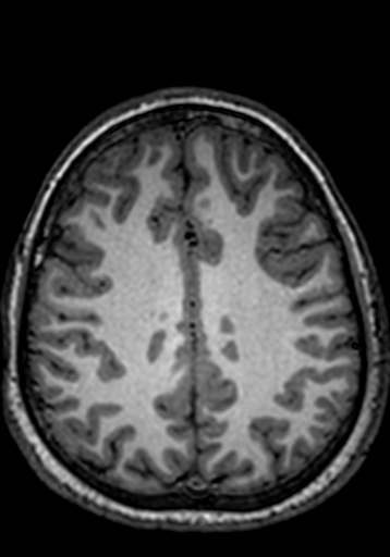 Cerebral arteriovenous malformation at posterior body of corpus callosum (Radiopaedia 74111-84925 Axial T1 82).jpg