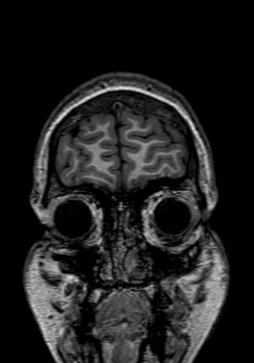 Cerebral arteriovenous malformation at posterior body of corpus callosum (Radiopaedia 74111-84925 Coronal T1 11).jpg