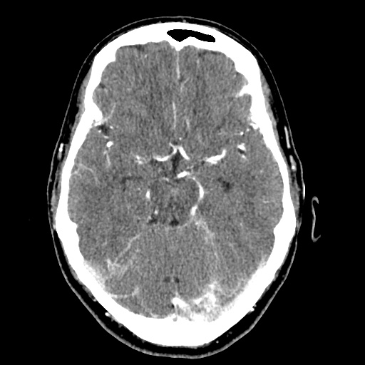 Cerebral arteriovenous malformation with lobar hemorrhage (Radiopaedia 35598-57216 A 23).jpg