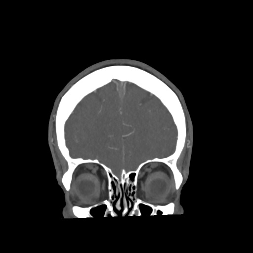 Cerebral arteriovenous malformation with lobar hemorrhage (Radiopaedia 35598-57216 C 17).jpg