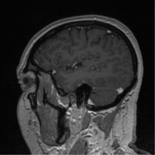 Cerebral cavernoma and development venous anomaly (Radiopaedia 37603-39482 Sagittal T1 C+ 74).png