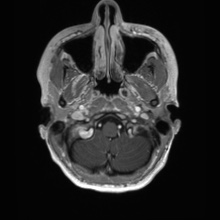 Cerebral cavernous venous malformation (Radiopaedia 70008-80021 Axial T1 C+ 5).jpg