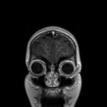 Cerebral cavernous venous malformation (Radiopaedia 70008-80021 Coronal T1 C+ 55).jpg