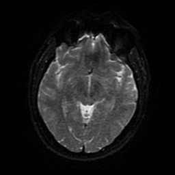 Cerebral cavernous venous malformation (Zabramski type II) (Radiopaedia 85511-101198 Axial DWI 81).jpg